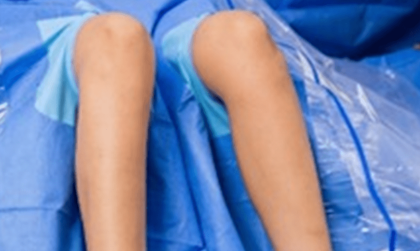 Bilateral Drape